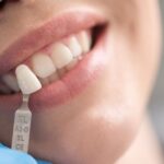 How Much Do Veneers Cost With Insurance Complete 2024 Price Guide