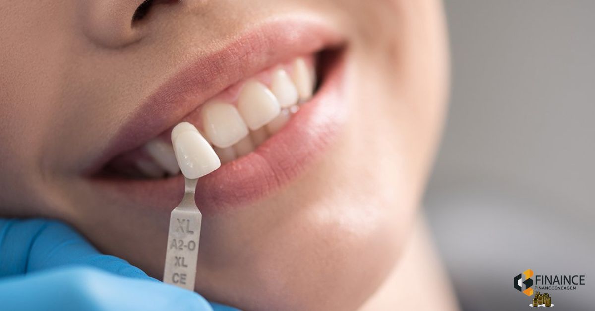 How Much Do Veneers Cost With Insurance Complete 2024 Price Guide